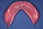 マイオデンチャー歯