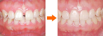 マウスピース型矯正歯科装置（クリアアライナー）による空隙閉鎖