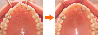 マウスピース型矯正歯科装置（クリアアライナー）による歯列の拡大とローテーション・コントロール