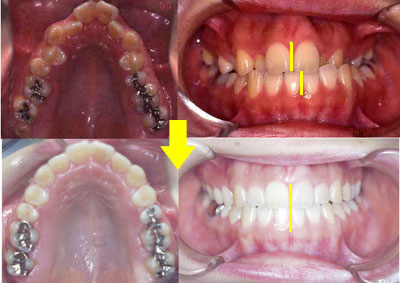 25才 左側TMJ症・非抜歯矯正治療