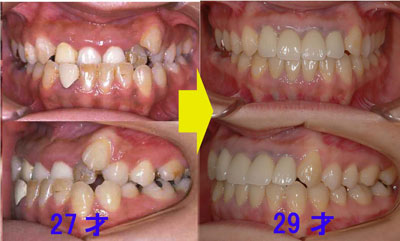 27才 骨格性Ⅲ級 非抜歯矯正治療