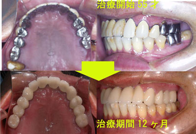 歯槽膿漏、補綴によるTMJ症改善