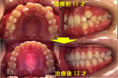 １１才 Ⅰ級叢生（八重歯）非抜歯矯正治療