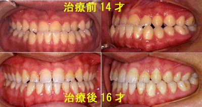 ４才 骨格性Ⅲ級 非抜歯矯正治療