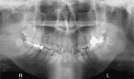 お口の中全部の歯の状態を見ます