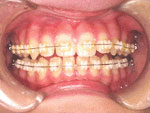永久歯を並べる治療