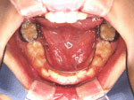 歯の裏側に装着するリンガル装置